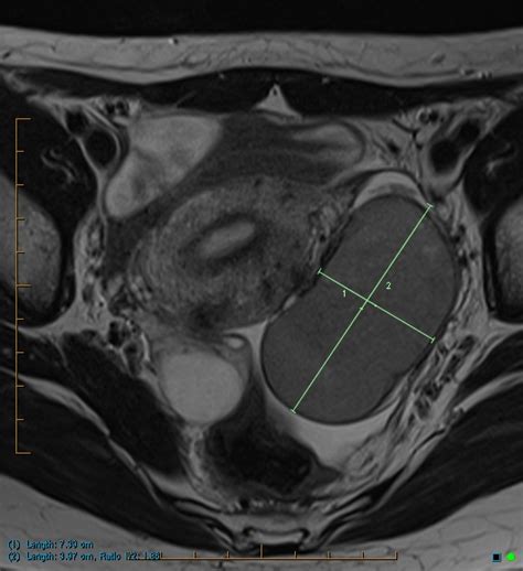 Ovarian endometrioma | Image | Radiopaedia.org