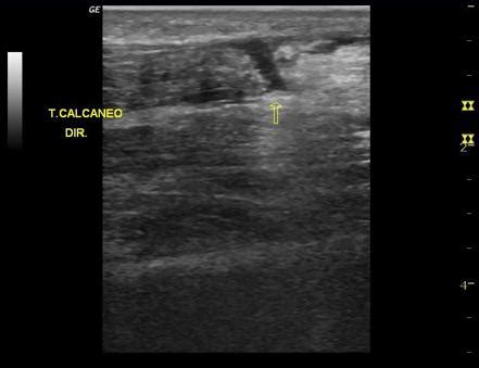 Achilles Tendon Partial Tear Ultrasound