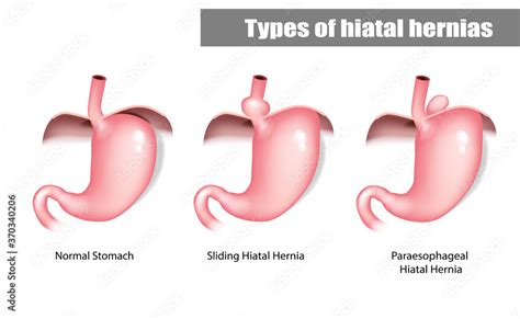 Types of hiatal hernias sliding and paraesophageal. Stock Vector ...