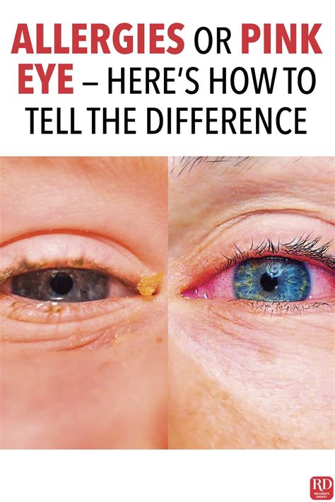 Allergies or Pink Eye: Here’s How to Tell the Difference | Itchy red ...