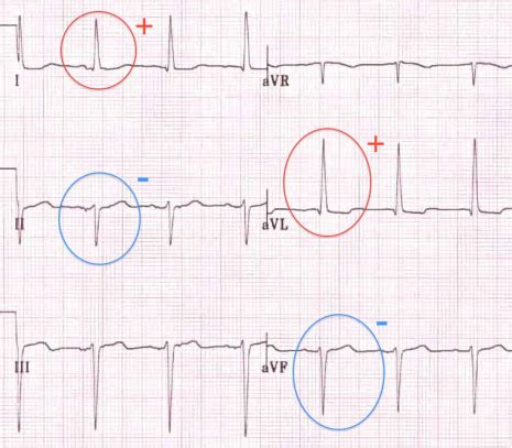 Differential Diagnosis of Left Axis Deviation on ECG - Medical Zone