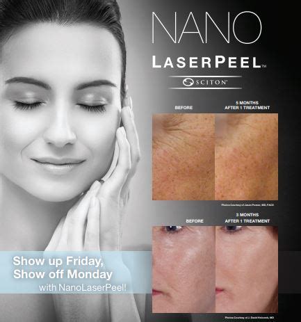 Micro Laser Peel Denver, CO | Highlands Ranch Micro Laser Peel