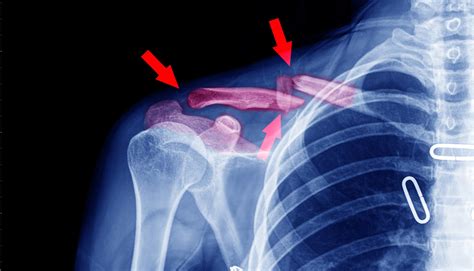 What Is the Average Settlement for a Broken Collarbone? | Laborde ...