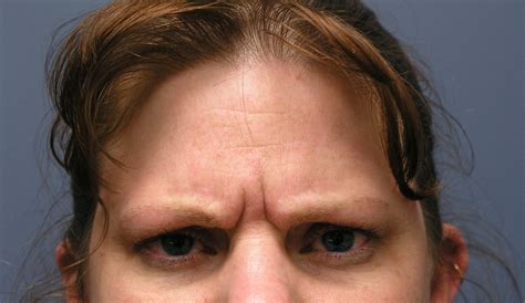 Patient D** - Archived images of Low Brow, Glabellar Furrow, and Wrinkling Forehead — Dr Giuffre ...