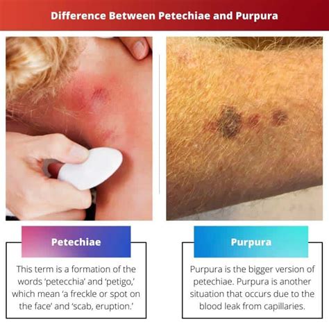 Difference Between Petechiae And Purpura