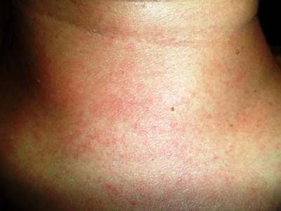 Prickly Heat Rash or Allergic Skin Rash