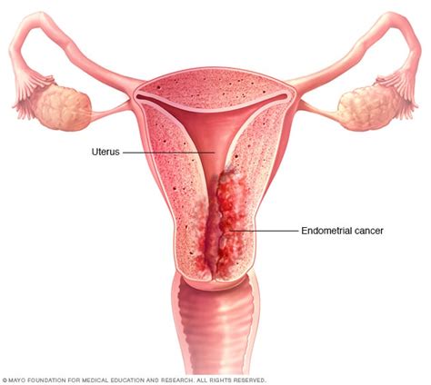 Endometrial cancer - Symptoms and causes - Mayo Clinic