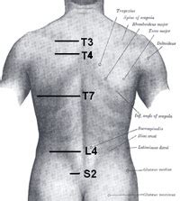 T4 Syndrome - Physical Therapy