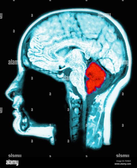 MRI scan of the brain, computer enhanced to highlight the cerebellum ...