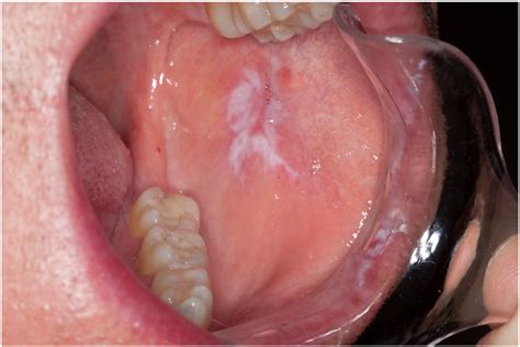 Oral lichen planus - Clinics in Dermatology