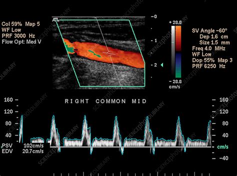 Carotid Duplex Ultrasound Exam - Stock Image - P206/0442 - Science Photo Library