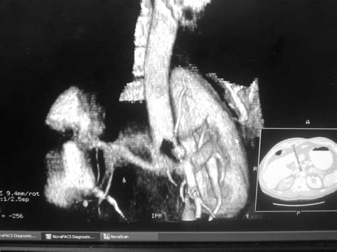 Home Based Business: A Day at the Office - Renal Infarct CT Scan