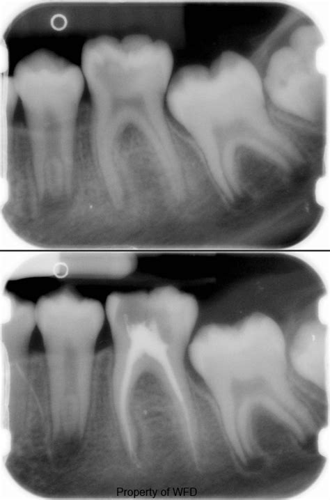 Root Canal Therapy - Witte Family Dentistry