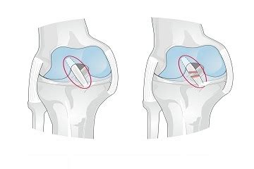 ACL Ligament Surgery In Bangladesh by Dr. Vikram Sharma