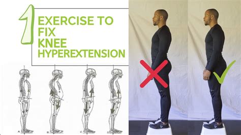 Knee Hyperextension (Fix Hyperextended Knees) - YouTube