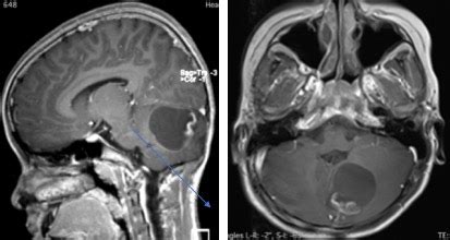 Pilocytic astrocytoma – Radiology Cases