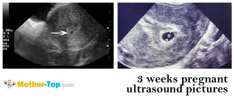 3 weeks pregnant ultrasound pictures