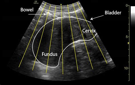 Pitfall : Retroverted uterus - Critical Care Sonography