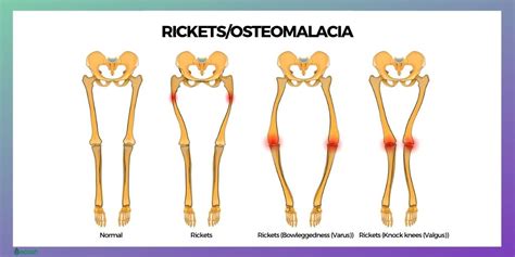 OSTEOMALACIA - Symptoms, Causes, Risk Groups, Prevention and Treatment ...