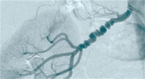 Fibromuscular dysplasia | Ireland| PDF | PPT| Case Reports | Symptoms | Treatment