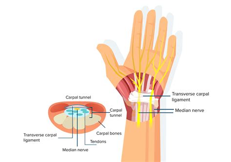 Carpal Tunnel Syndrome – OMNE Chiropractic