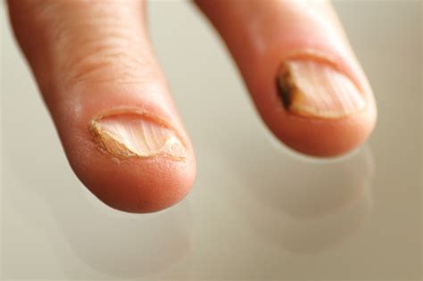 Nail Infection - What causes fungal fingernail infections?