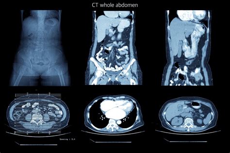 CT Scan | CTA Scan | California | Centrelake Imaging