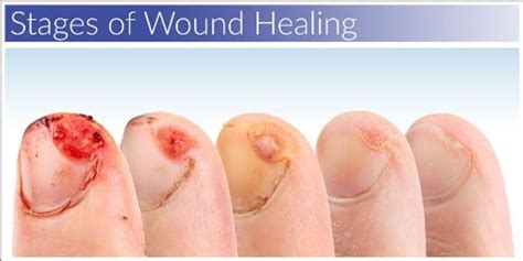 Wound Healing | Page 7 | Trending