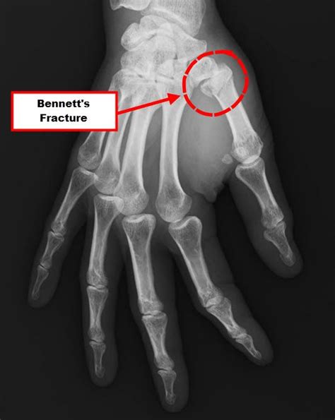 Bennett's Fracture: Break At The Base of Your Thumb