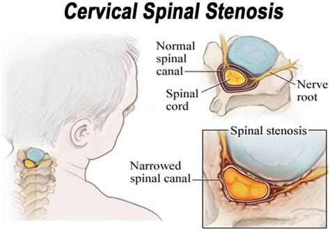 Spinal stenosis causes, symptoms, diagnosis, treatment and exercises