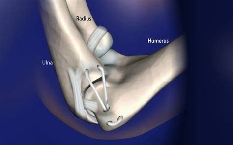 Tommy John Surgery Cost - Updated 2023 - The Pricer