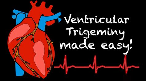 EMS Cardiology || Tachy Tuesday: Ventricular Trigeminy - YouTube