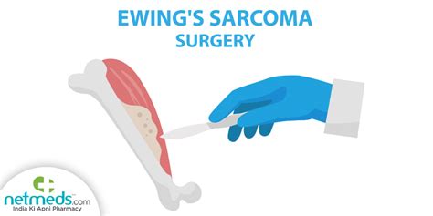 Ewing’s Sarcoma: Causes, Symptoms And Treatment