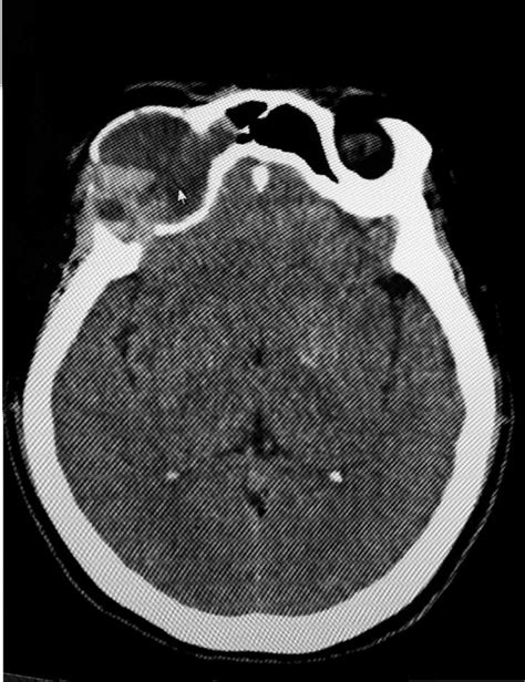 Heterogenous septated hypodense lesion with no intracranial extension. | Download Scientific Diagram