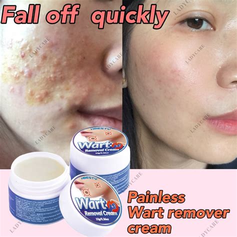 Wart Removal Cream Fast Remove Skin Tag Remover Original Ointment ...