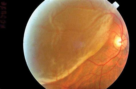 AAEM Resident and Student Association : Retinal Detachment: What You ...