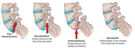 Anterolisthesis causes, symptoms, diagnosis, grades, treatment & exercises