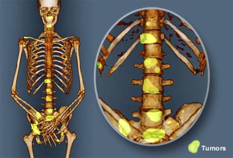 Healthy Life: Bone Metastasis