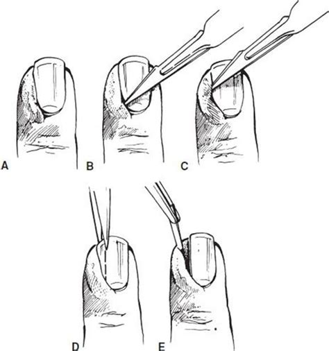 Paronychia Drainage Technique