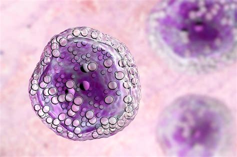 A Review of Clinical Outcomes in Patients With Early-Stage Burkitt Lymphoma - Oncology Nurse Advisor