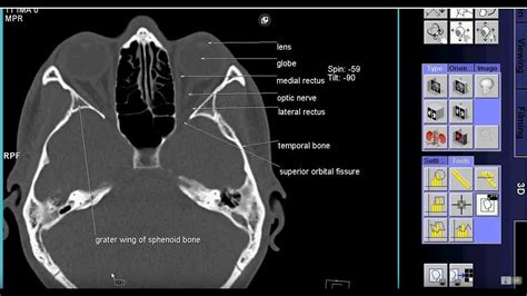 how to read ct scan PNS axial view With Text - YouTube