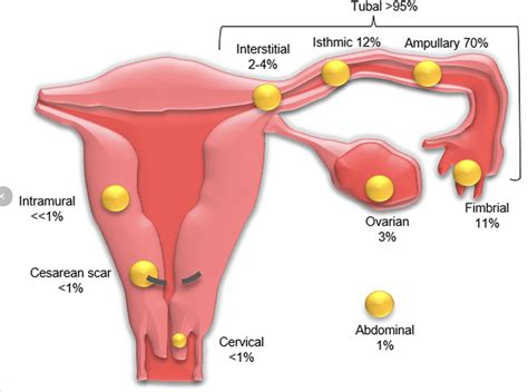 Oh MAN! - Interstitial Ectopic — Kwak Talk