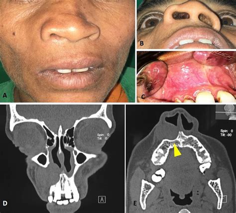 Nasolabial cyst: a rare non-odontogenic orofacial cyst | BMJ Case Reports