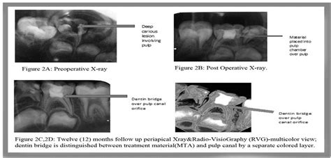 Sequential steps of Pulpotomy done by MTA | Download Scientific Diagram