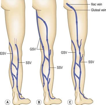 The Great Saphenous Vein (GSV) | Short Saphenous Vein (SSV) | La Jolla