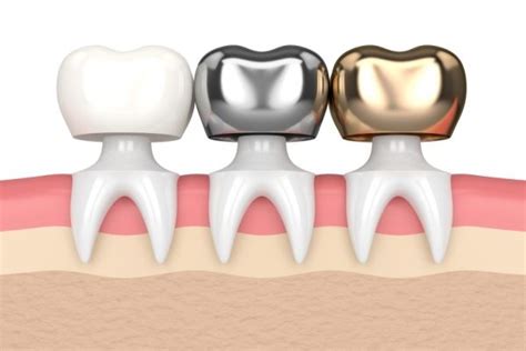 Types of Crowns Used as Dental Restoration