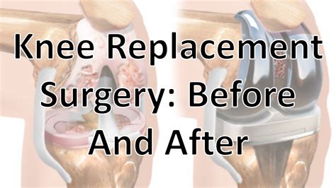 Diagram Of Knee Replacement Surgery