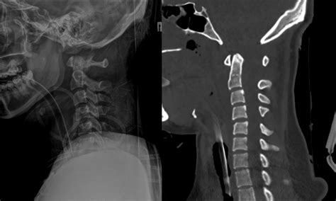 Cervical spine X-ray (left) and CT scan (right). | Download Scientific ...