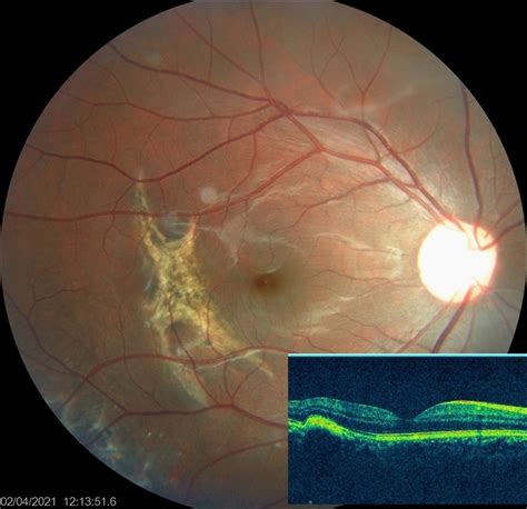 Choroidal Rupture - Retina Image Bank