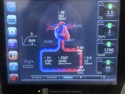 melocotón transatlántico Aburrido invasive hemodynamic monitoring ...